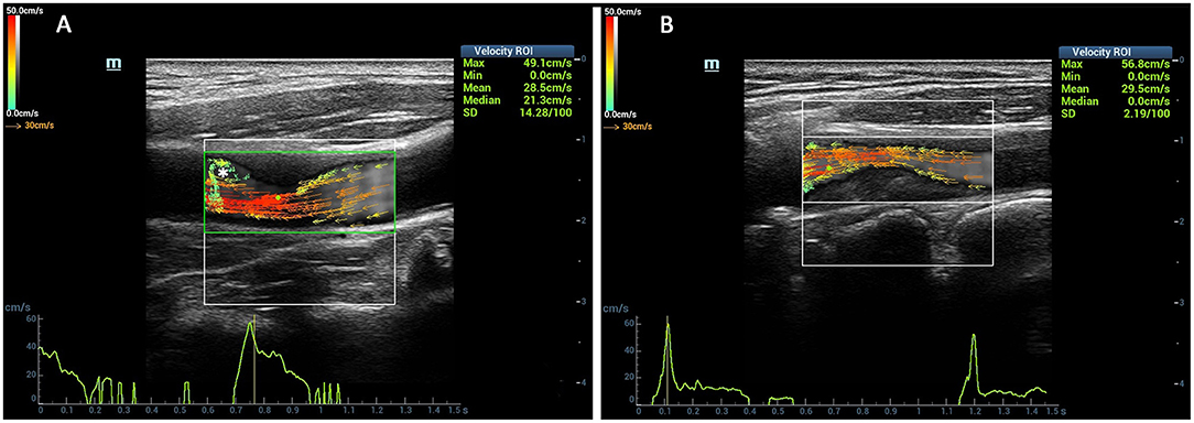 A TIPIC Ultrasonographic B-Mode Imaging of the Common Carotid