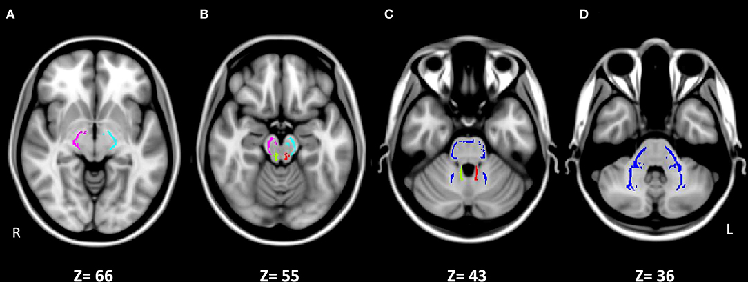 Frontiers Altered Cerebellar White Matter In Sensory Processing Dysfunction Is Associated With Impaired Multisensory Integration And Attention Psychology