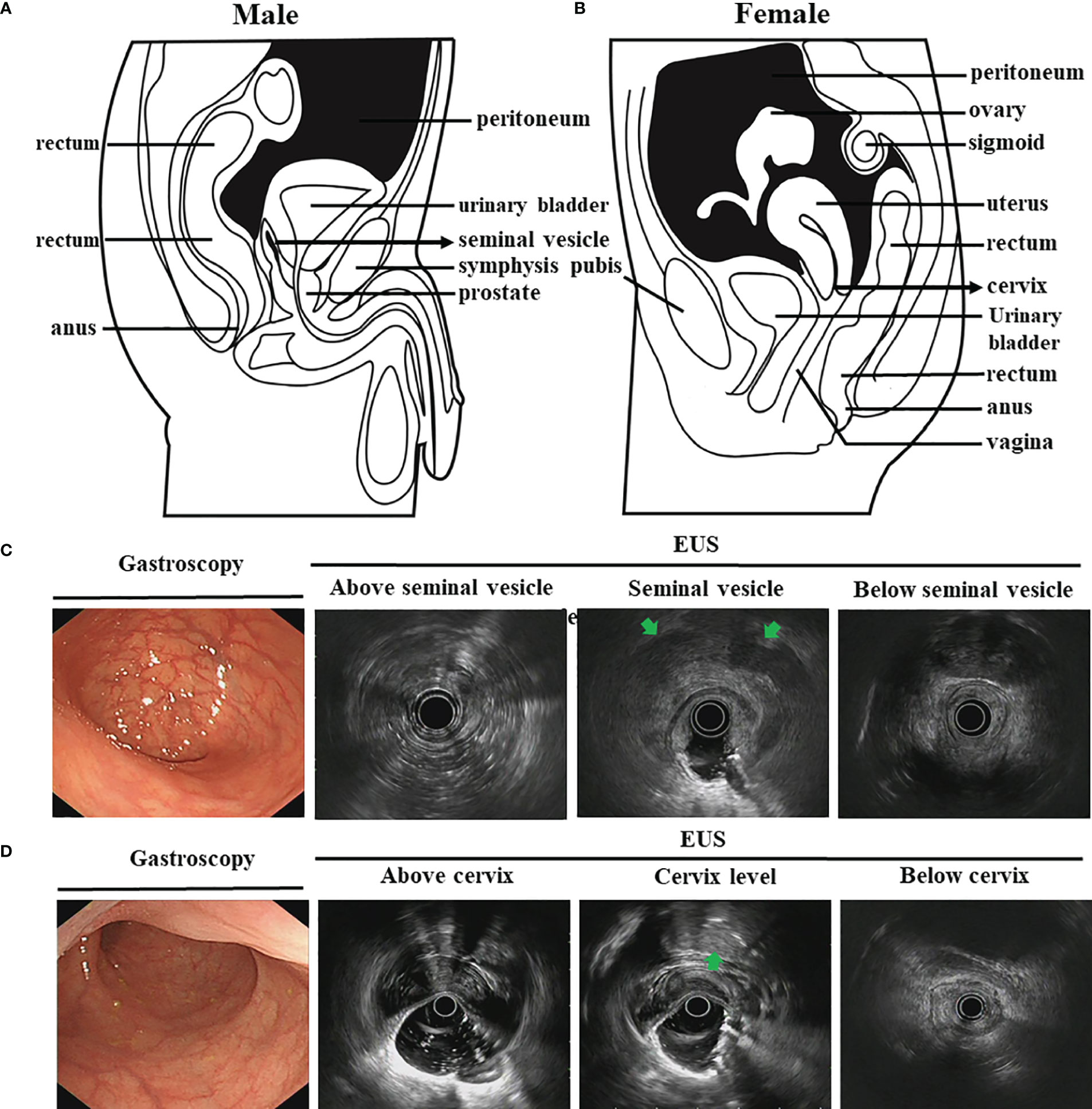 Frontiers How Useful Is Endoscopic Ultrasound In Differentiating T3t4a T Stage Of Colorectal