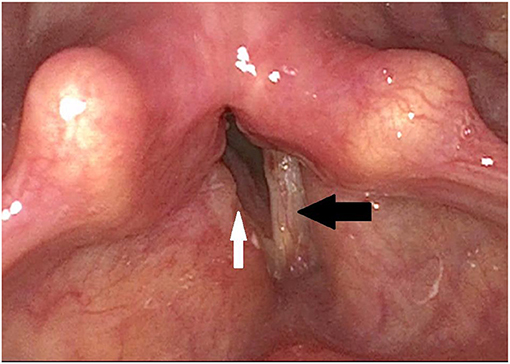 vocal cords damaged