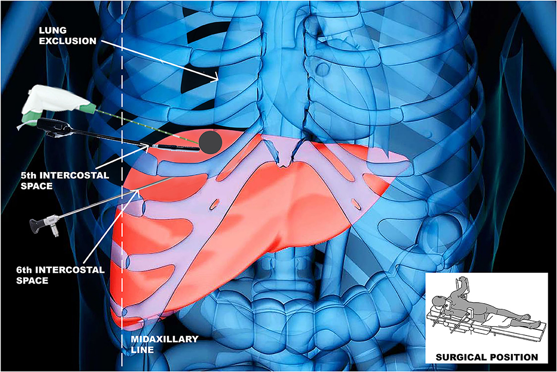 Frontiers | Thoracoscopic Ablation of Critically Located Liver
