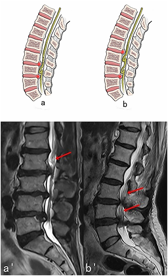 Imaging and clinical presentation of degenerative lumbar spinal stenosis