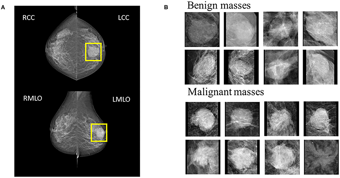 frontiers-improving-the-prediction-of-benign-or-malignant-breast