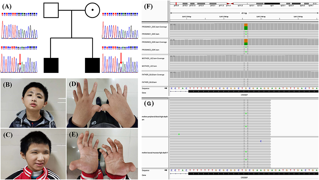 CREBBP and EP300 mutational spectrum and clinical presentations in a cohort  of Swedish patients with Rubinstein–Taybi syndrome - Wincent - 2016 -  Molecular Genetics & Genomic Medicine - Wiley Online Library
