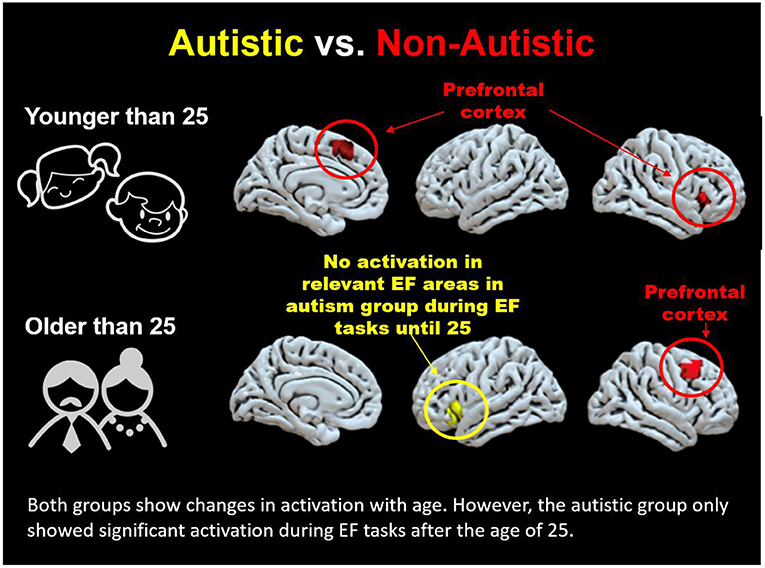 autism brain comparison