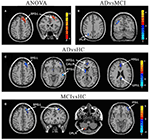 Frontiers | Differences Changes in Cerebellar Functional Connectivity ...