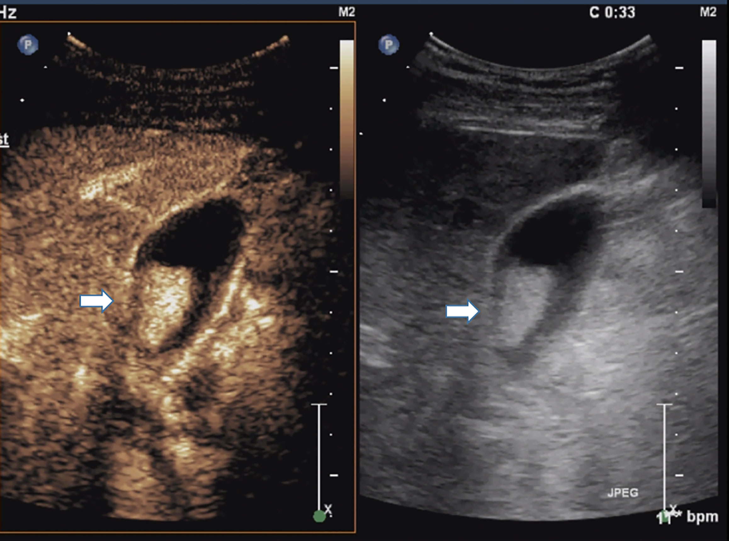Gallbladder Polyps Ultrasound