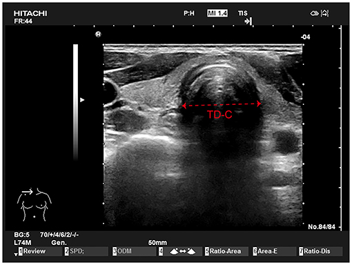 Frontiers  Prediction of Left Double-Lumen Tube Size by Measurement of  Cricoid Cartilage Transverse Diameter by Ultrasound and CT Multi-Planar  Reconstruction