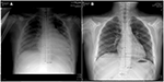 Frontiers | Case Report: Application of Thoracoscopic Clamp ...