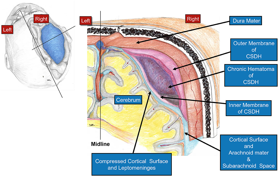 Frontiers | The Mini-Craniotomy for cSDH Revisited: New Perspectives