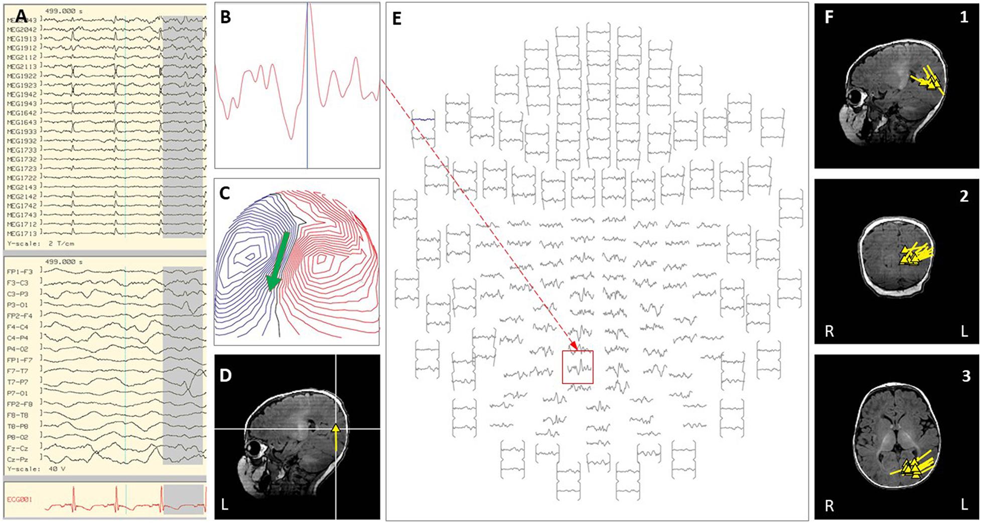 Frontiers | Indications for Inpatient Magnetoencephalography in ...