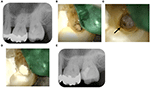 Frontiers | Partial Pulpotomy to Successfully Treat a Caries-Induced ...