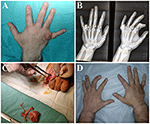 Frontiers | Case Report: Osteomyelitis of the Proximal Phalanx of the ...