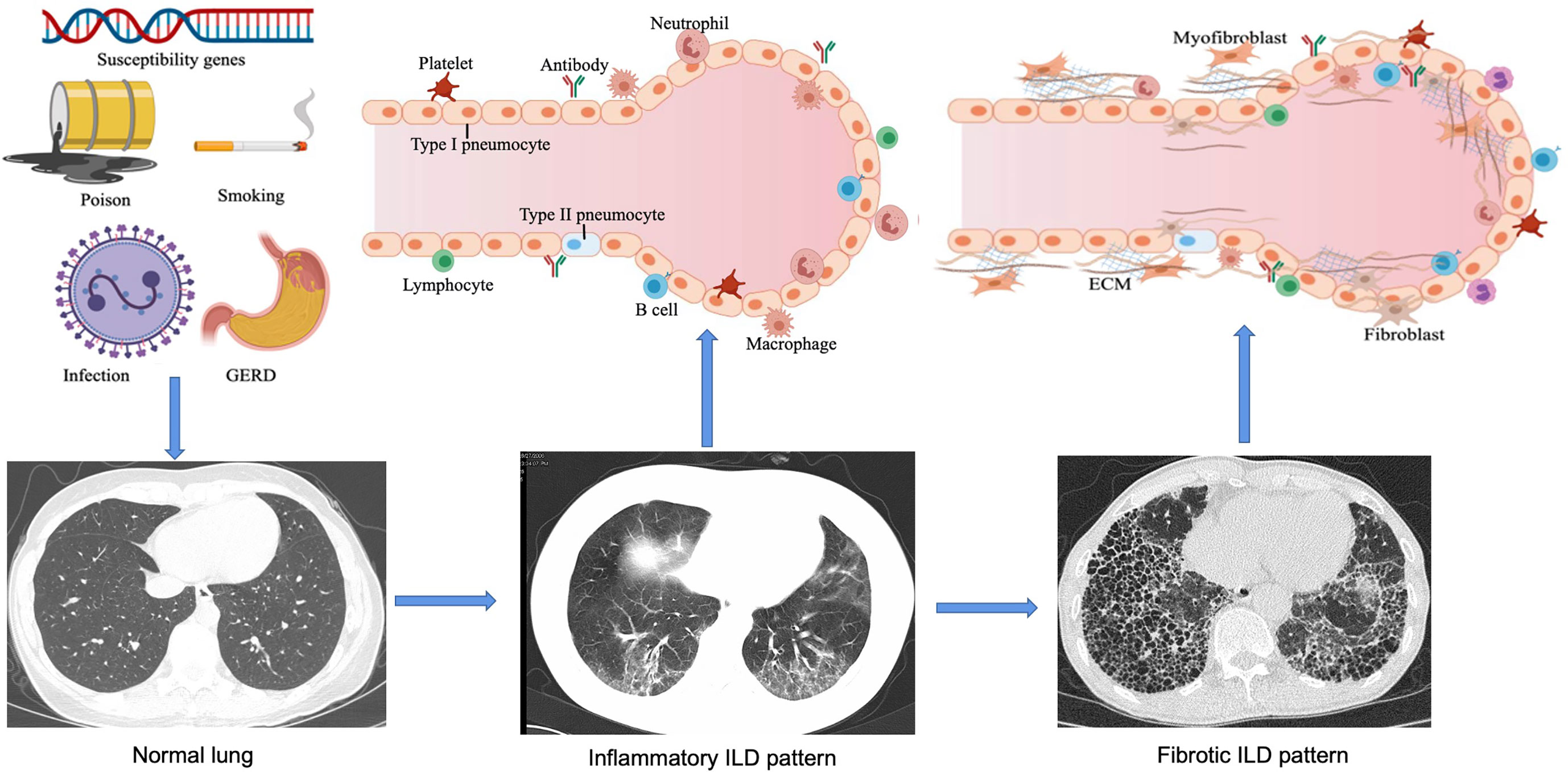 Frontiers | Interstitial Lung Disease in Connective Tissue Disease: A ...