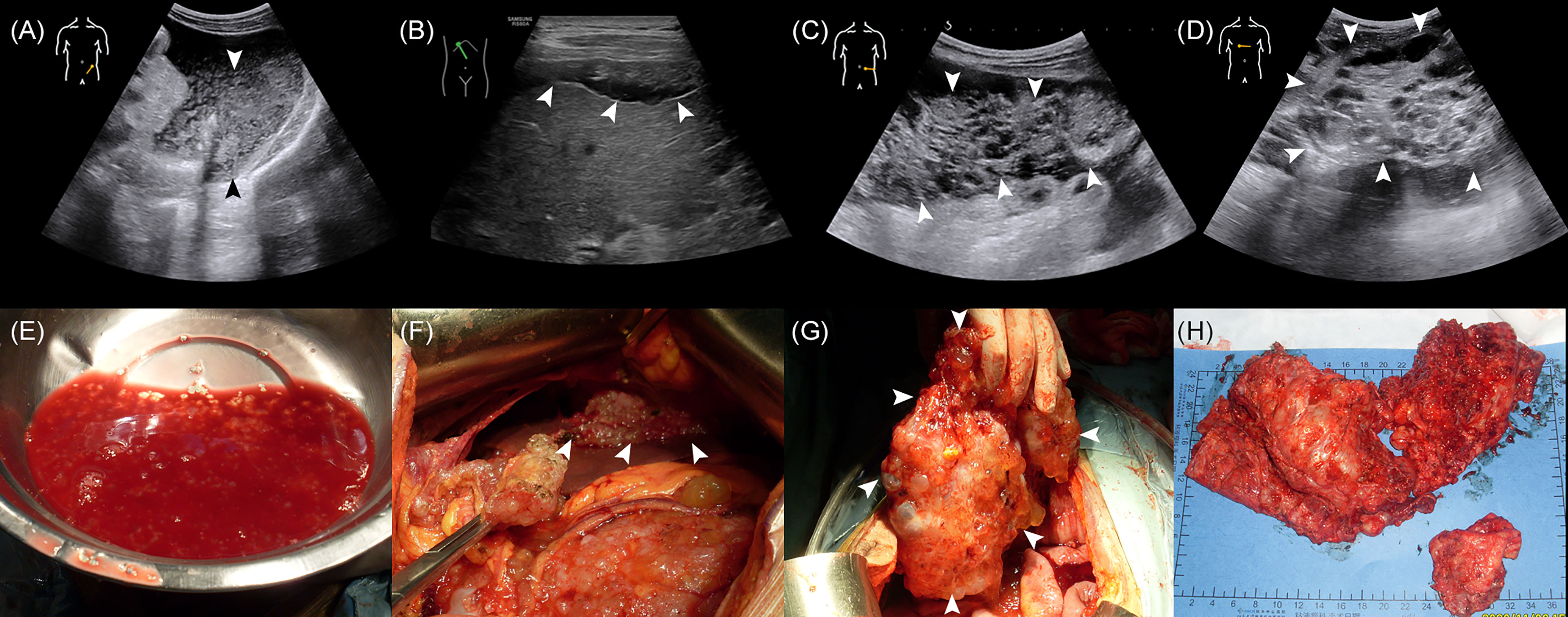 Abdomen and retroperitoneum | 1.7 Peritoneum mesentery and omentum : Case  1.7.5 Mesenteric and peritoneal metastases | Ultrasound Cases