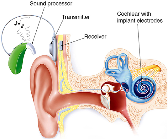 Figure 2 - Ear with a cochlear implant.