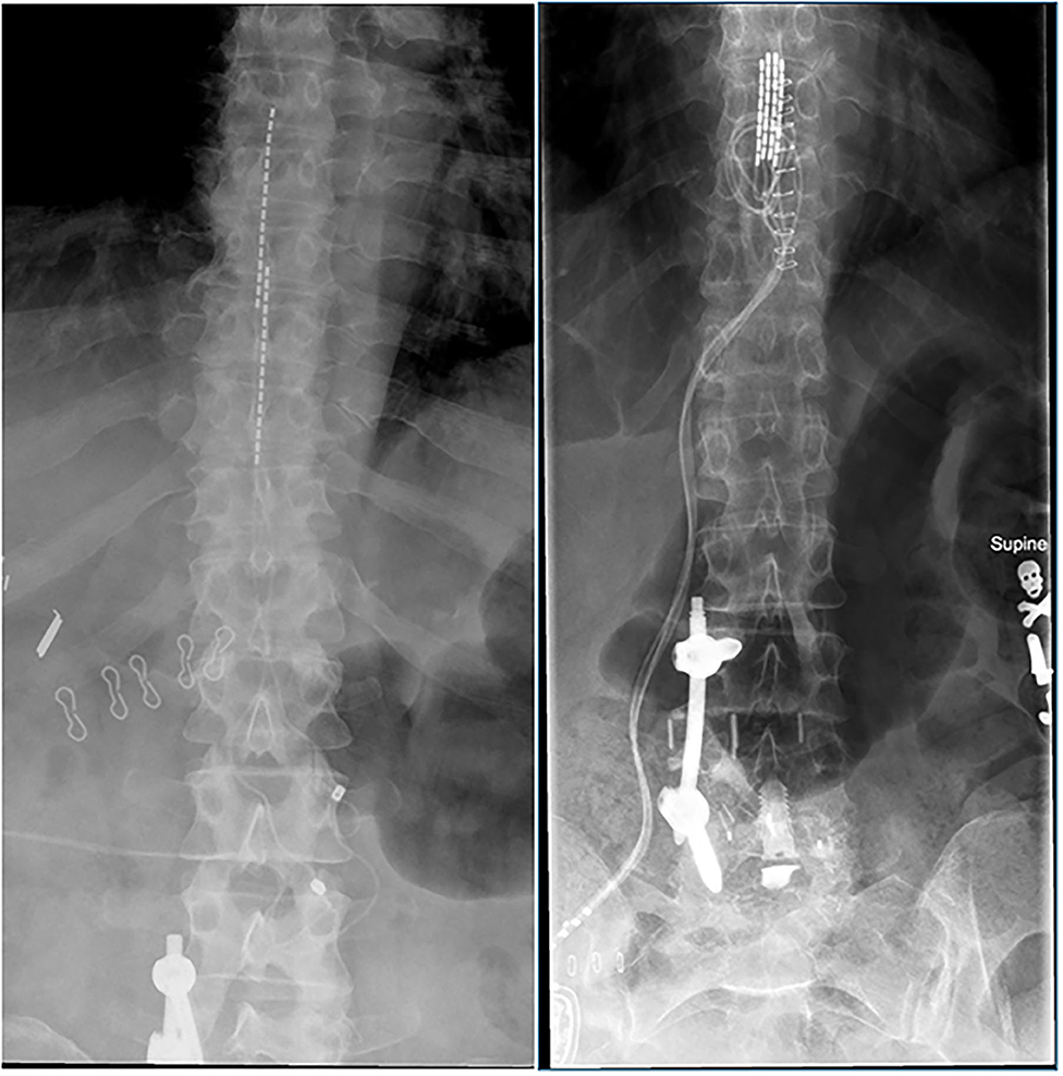 Am I a Candidate for a Spinal Cord Stimulator?: Advanced Pain