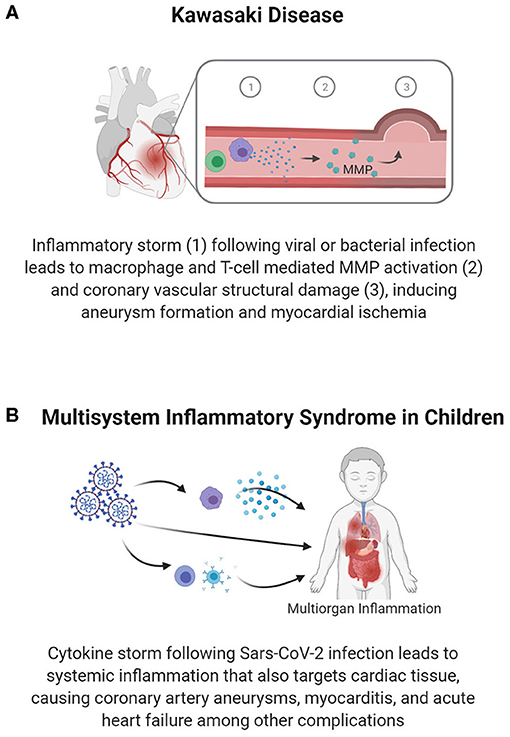 Acute Heart Failure in Multisystem Inflammatory Syndrome in