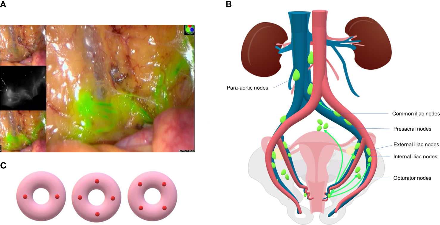 Frontiers  Sentinel Lymph Node Mapping in Endometrial Cancer: A
