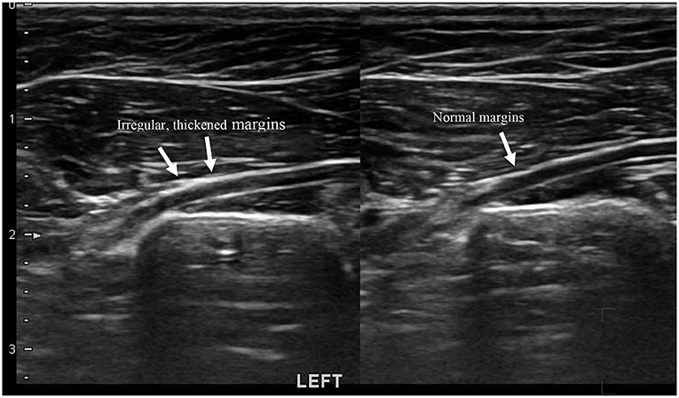 Piriformis Syndrome Ultrasound