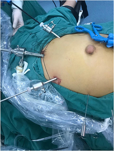 The Cosmetic Lane on X: An extreme case of Umbilical Hernia