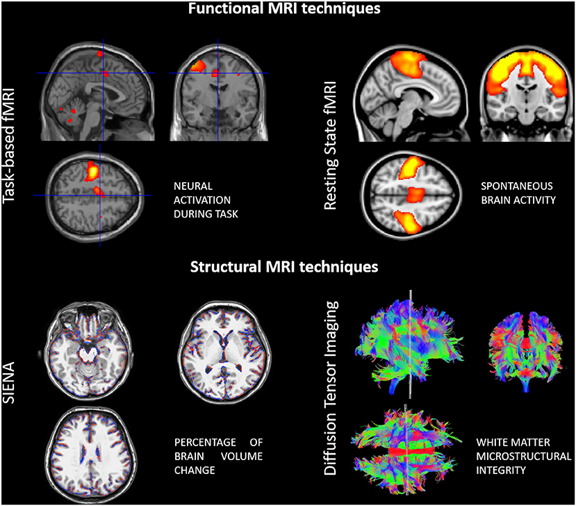 Frontiers  Neuroplasticity and Motor Rehabilitation in Multiple