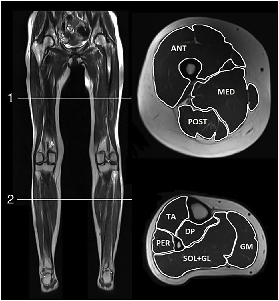 Frontiers | Quantitative Muscle MRI Clinical Findings Women Pathogenic Variants Dystrophin and in Gene With