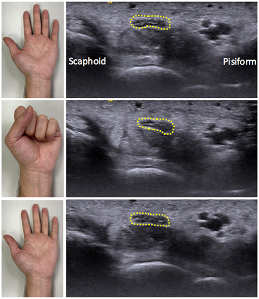 Frontiers Dynamic Ultrasound Assessment Of Median Nerve Mobility