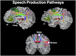 Frontiers | Reducing the Cognitive Footprint of Brain Tumor Surgery ...