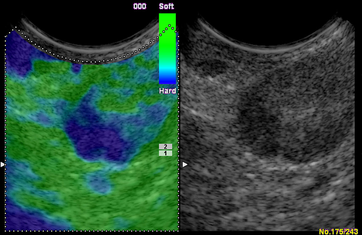 Frontiers  Ultrasound Elastography for the Evaluation of Lymph Nodes