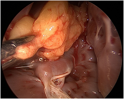 Intracavitary Left Ventricular Lipoma