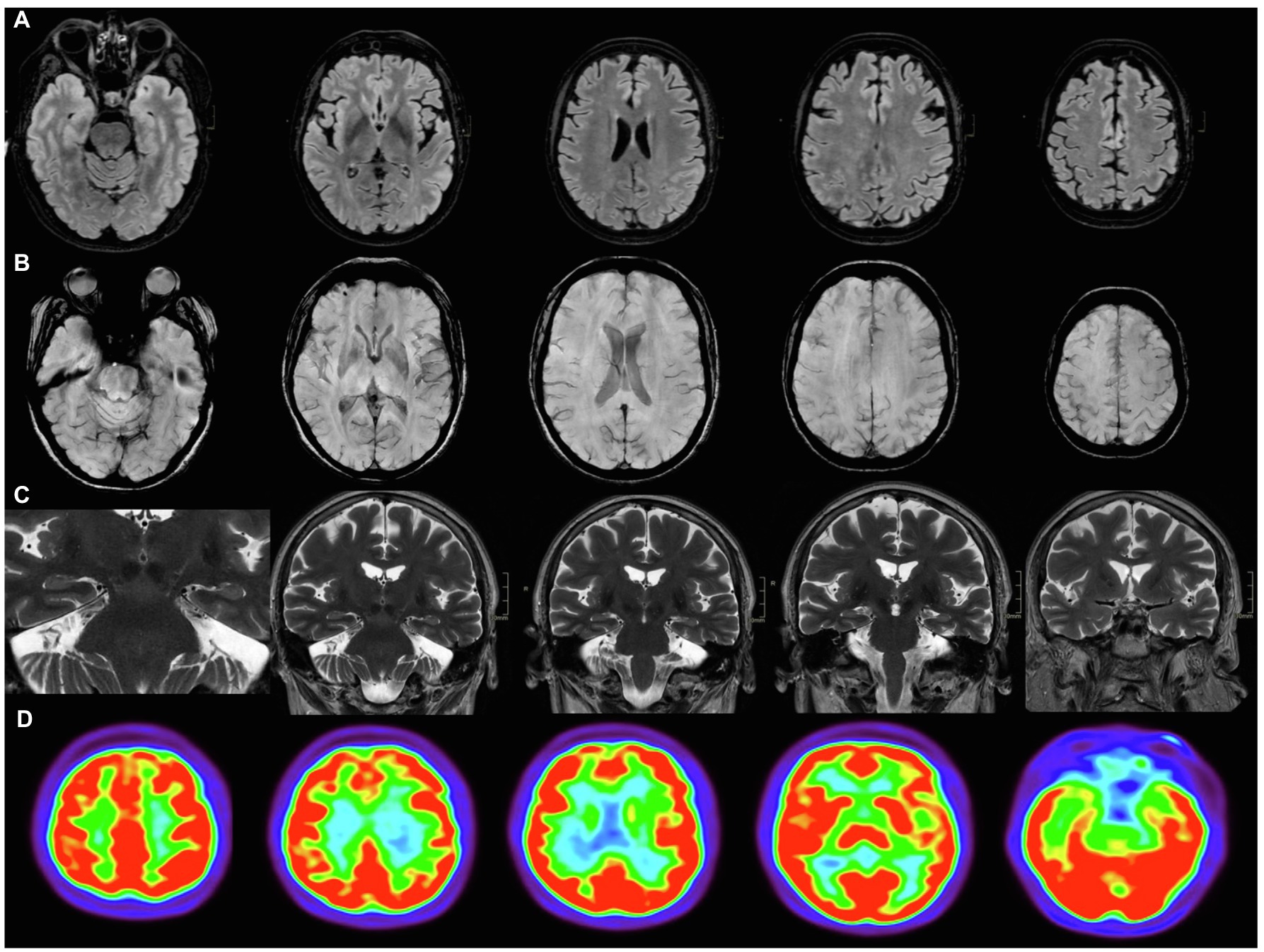 Frontiers  “Brain Fog” by COVID-19 or Alzheimer's Disease? A Case