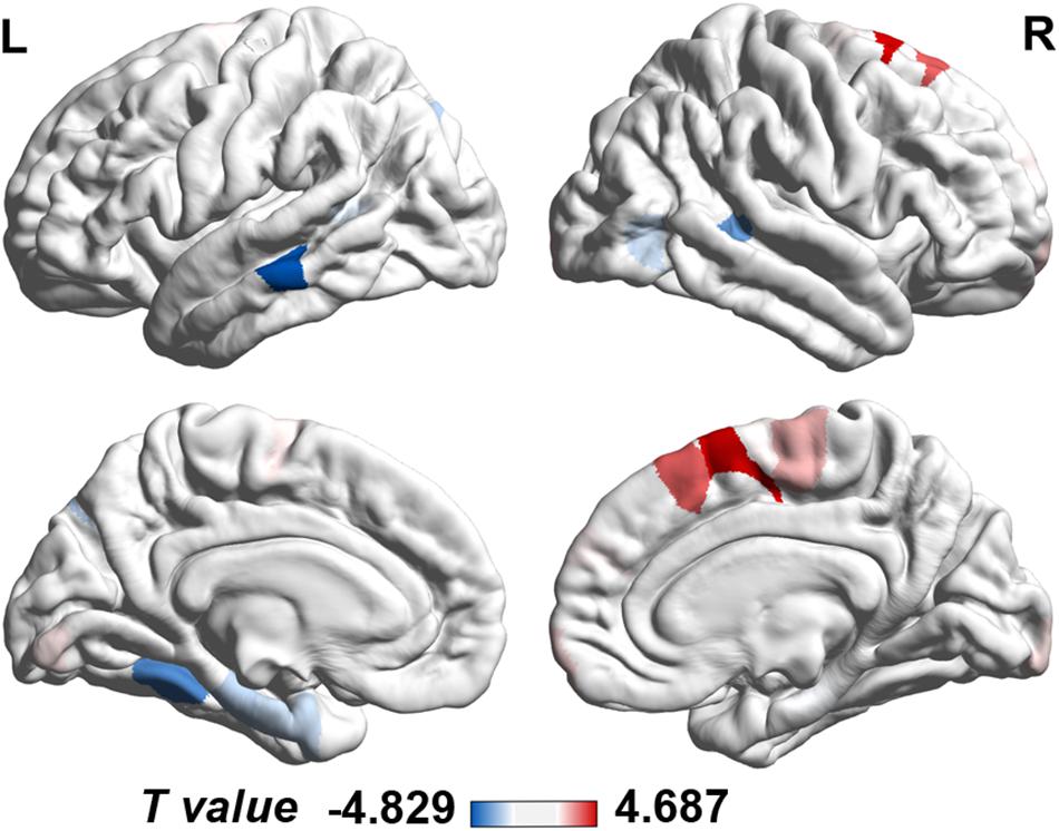 Frontiers  Morphometric and Functional Brain Connectivity