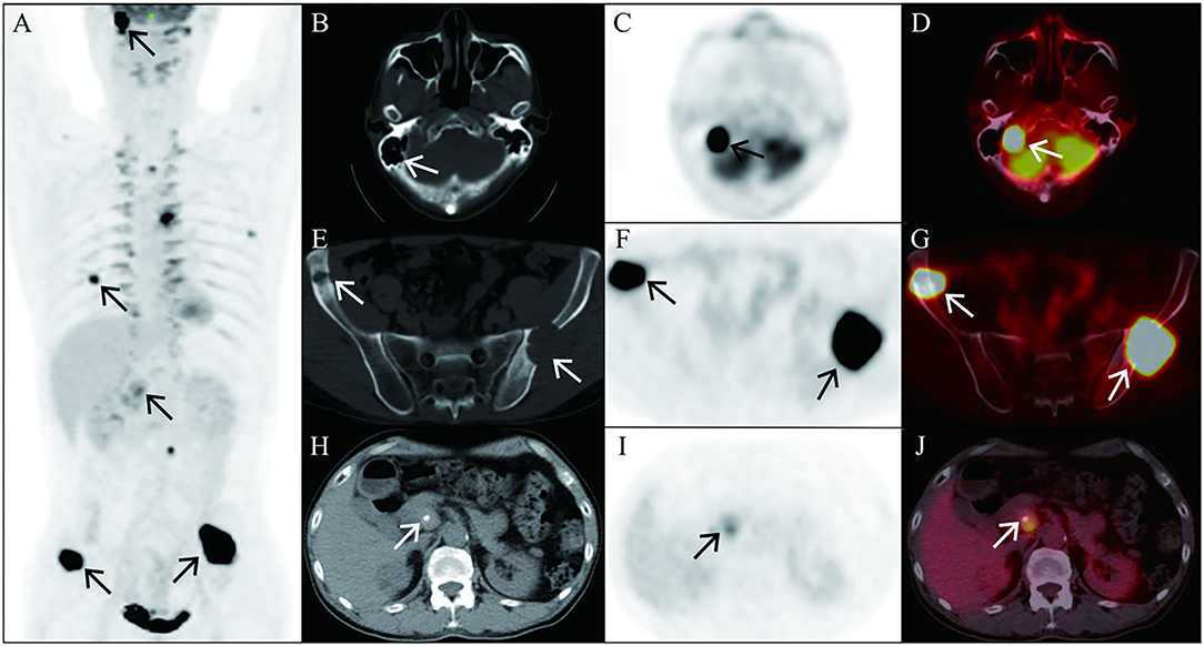 Frontiers | 18F-FDG PET/CT in a Patient With Malignant Pheochromocytoma ...