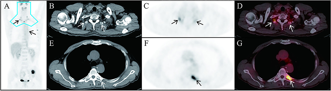 Frontiers 18f Fdg Petct In A Patient With Malignant Pheochromocytoma