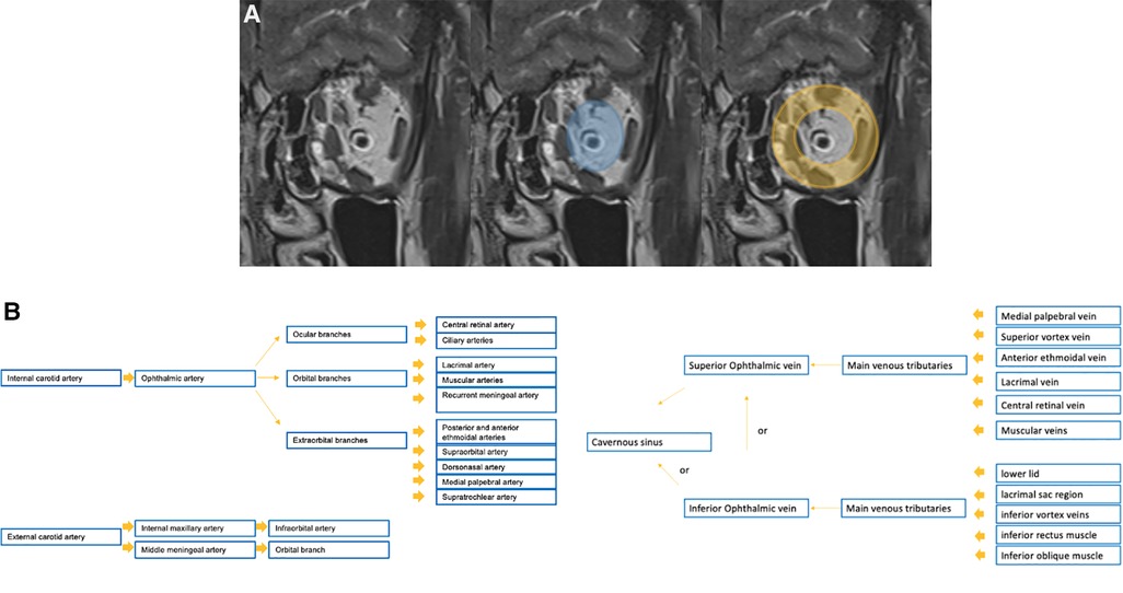 Frontiers  Vascular lesions of the pediatric orbit: A radiological  walkthrough