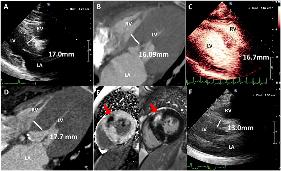 Frontiers  Selective Interventricular Septal Radiofrequency Ablation in  Patients With Hypertrophic Obstructive Cardiomyopathy: Who Can Benefit?