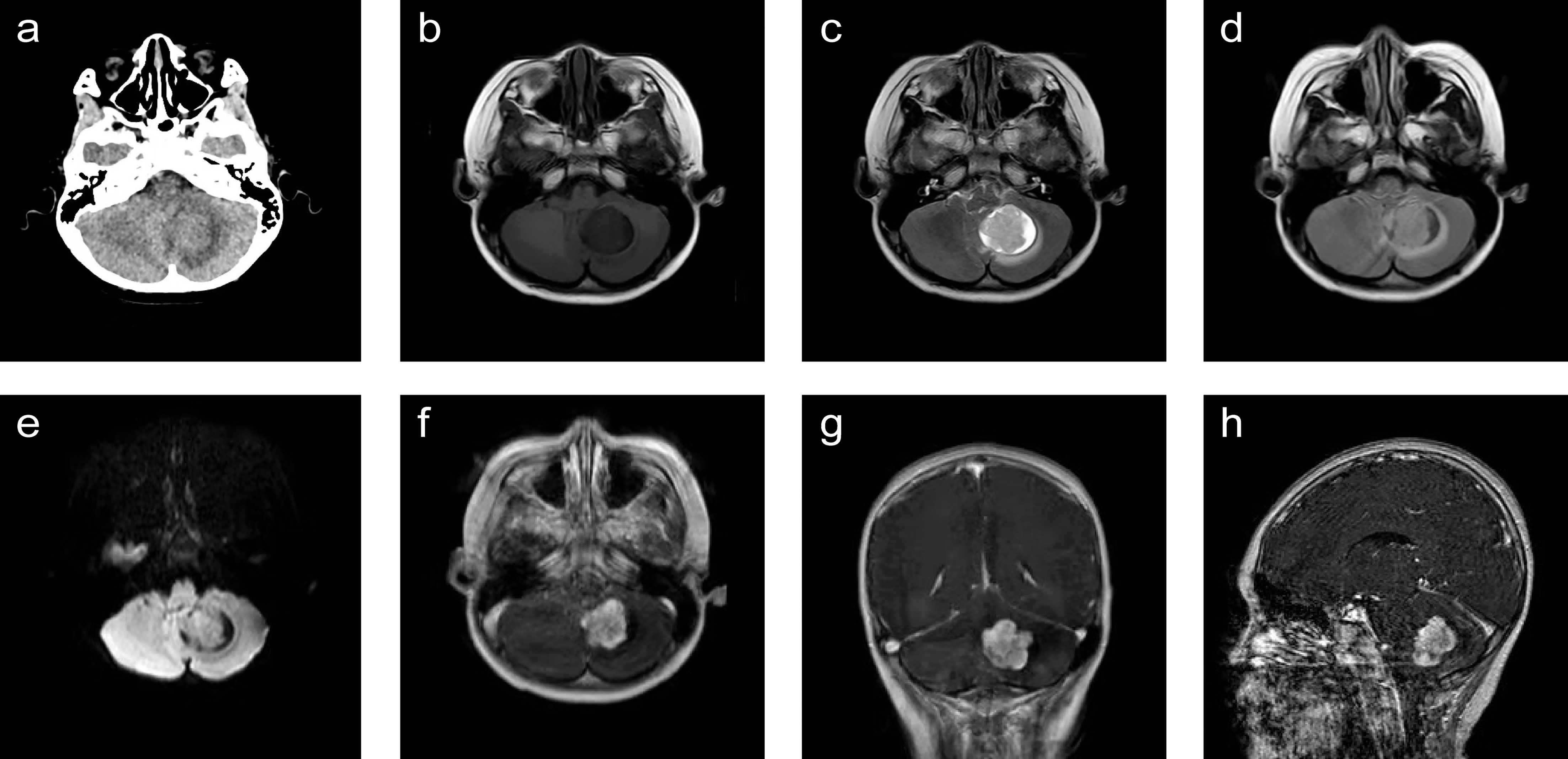 Frontiers Primary Yolk Sac Tumor In The Cerebellar Hemisphere A Case 