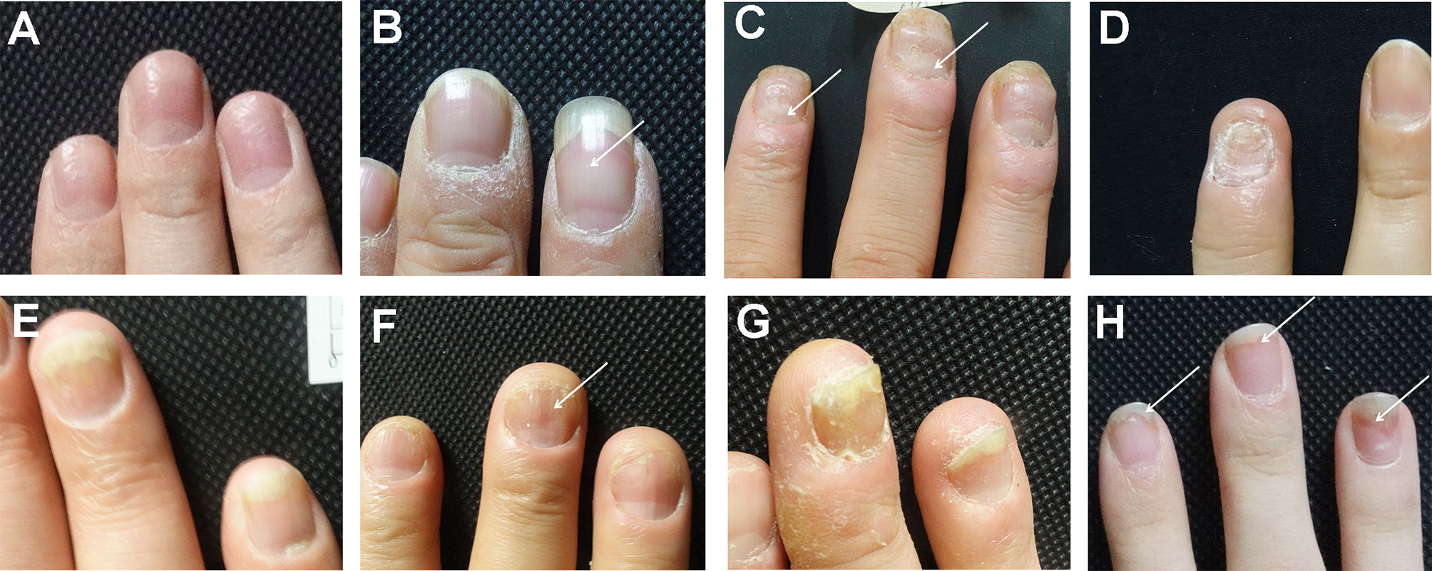 People with Nail Psoriasis May Have a Higher Chance of Developing PsA