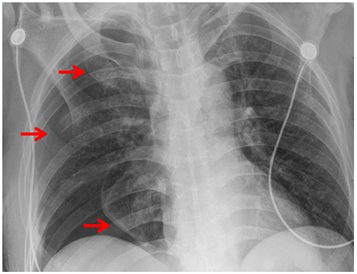 pigtail catheter pneumothorax