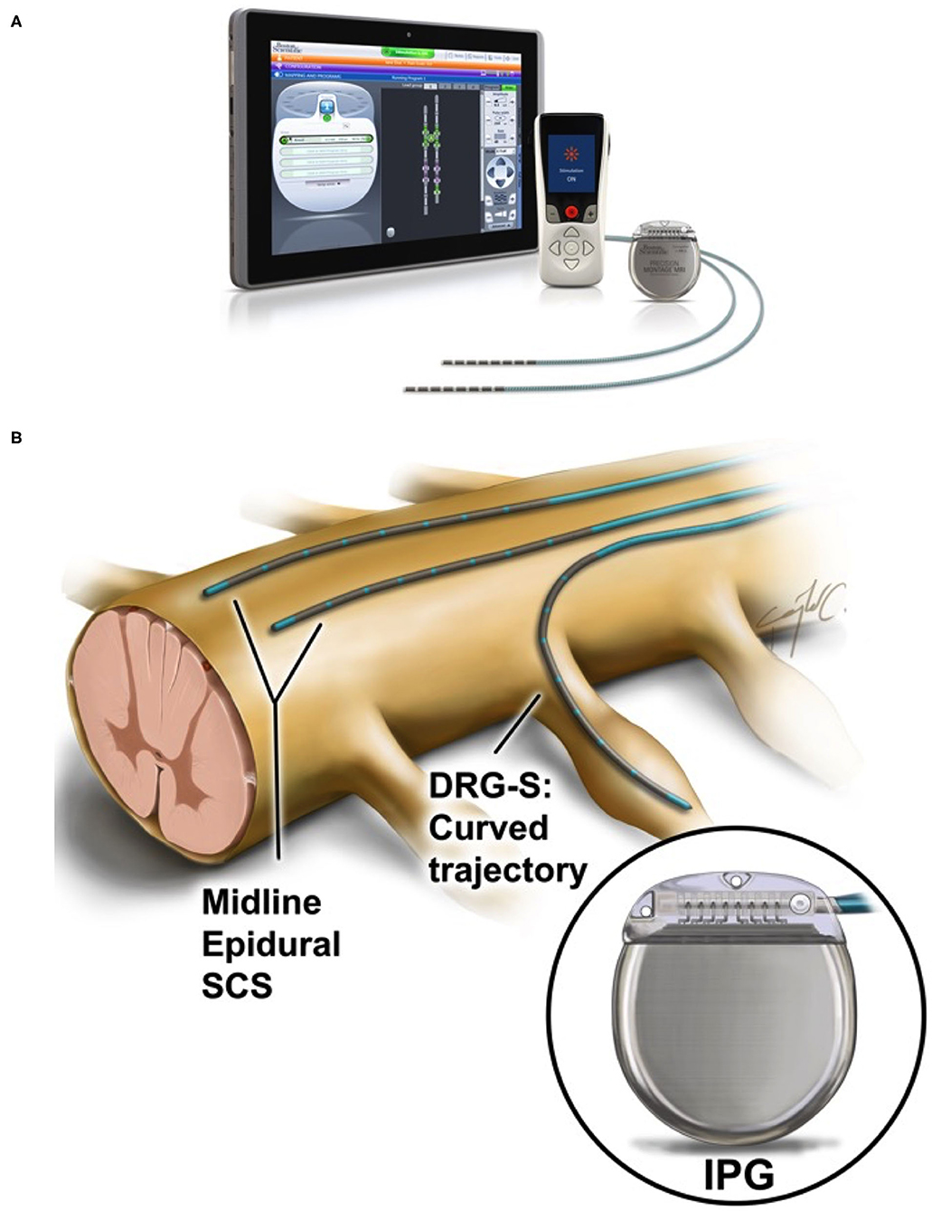 abbott spinal cord stimulator electronic details