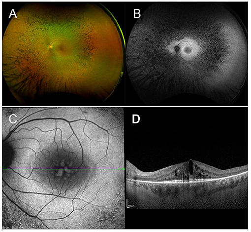 Retina - Gene Vision