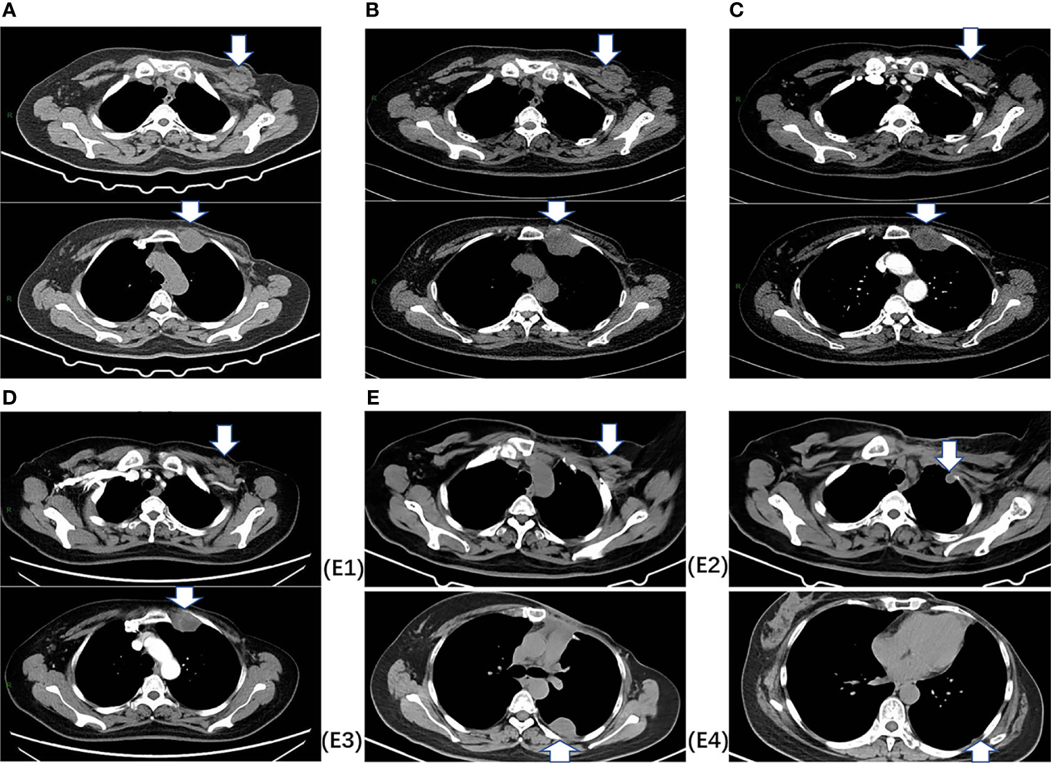 An 80-year-old woman with local chest wall recurrence of breast cancer
