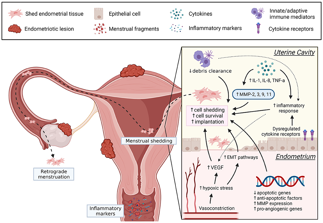 Neonatal uterine bleeding at birth and endometriosis later in life