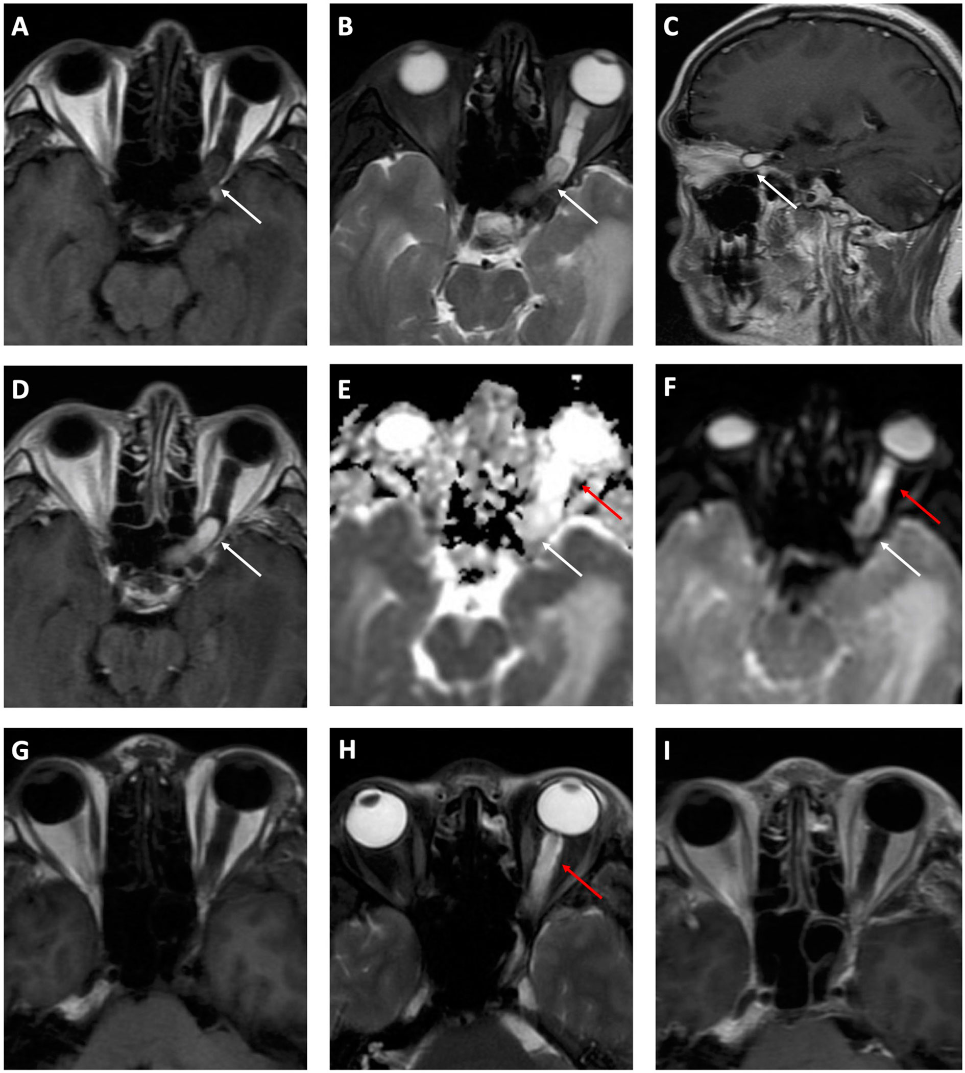 Frontiers Neuroimaging Features Of Optic Nerve Hemangioblastoma 