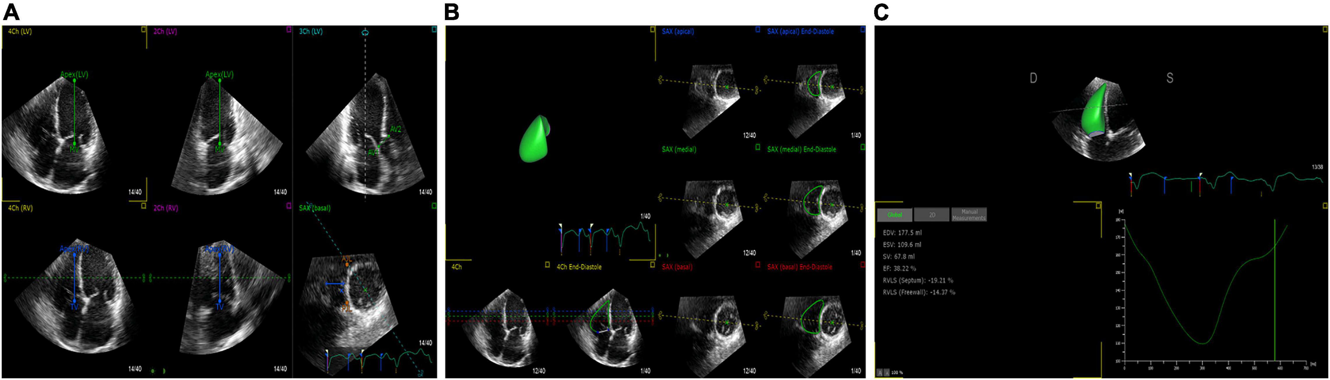 Frontiers  Evaluation of Right Ventricular Myocardial Mechanics by 2- and  3-Dimensional Speckle-Tracking Echocardiography in Patients With an  Ischemic or Non-ischemic Etiology of End-Stage Heart Failure