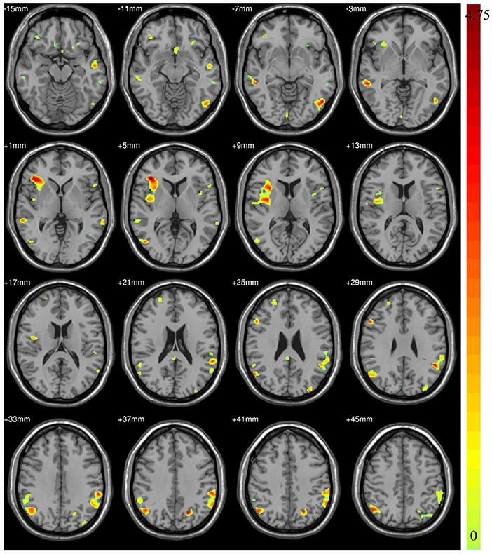 Clinical and mutational spectrum in Korean patients with Rubinstein–Taybi  syndrome: The spectrum of brain MRI abnormalities - ScienceDirect
