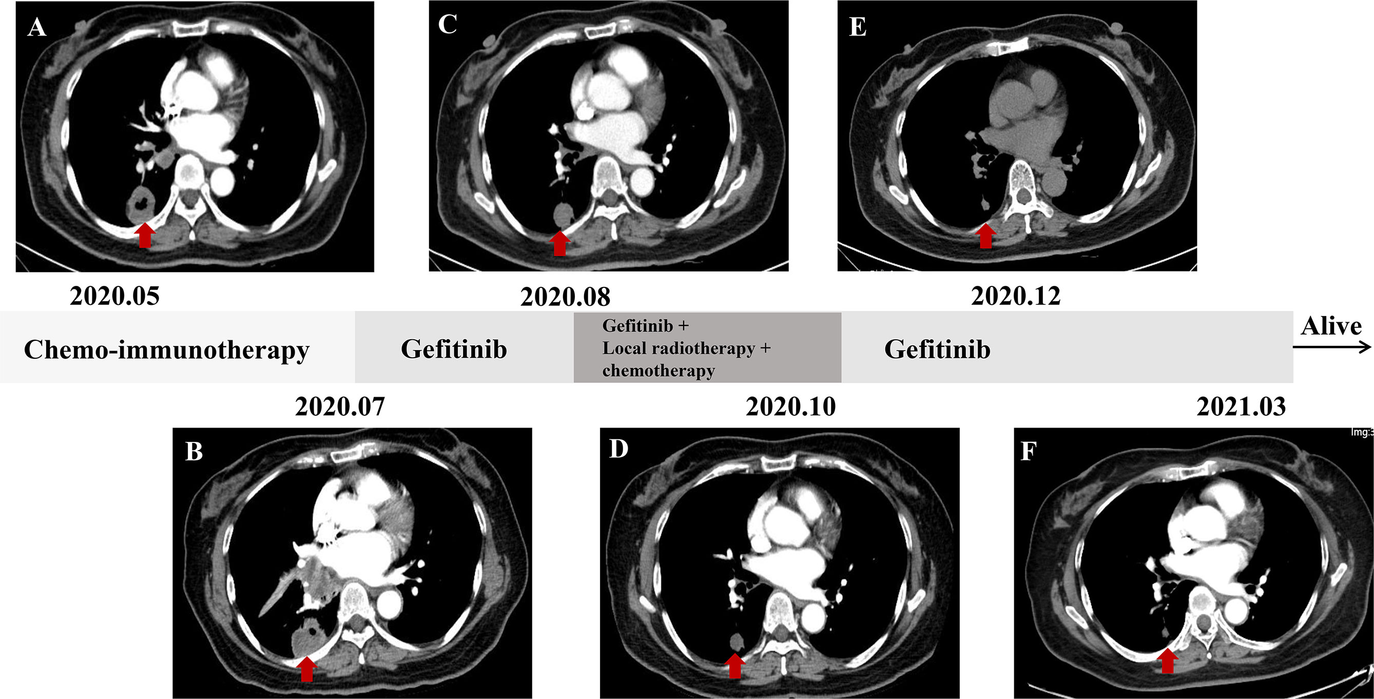 Frontiers | Case Report: An “Immune-Cold” EGFR Mutant NSCLC With 