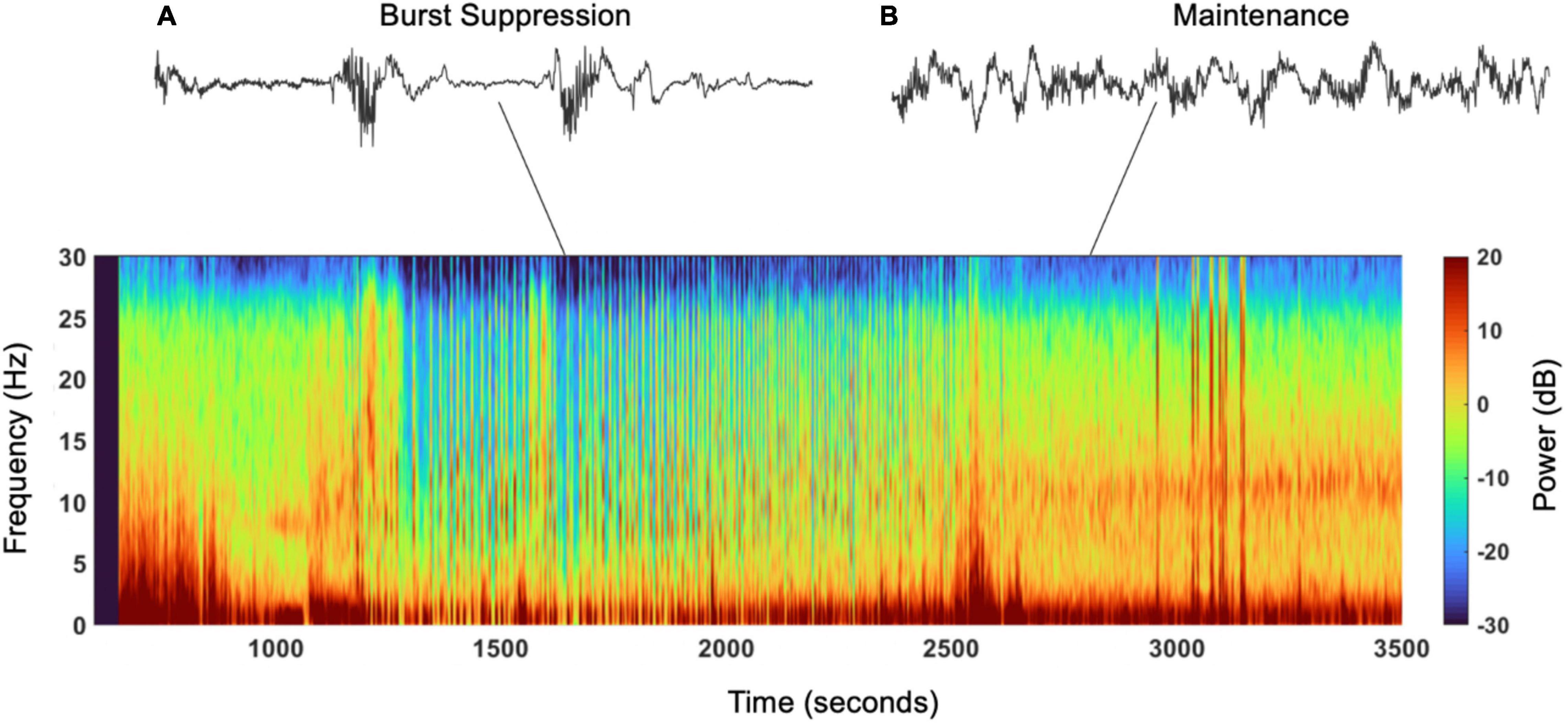 Frontiers  Burst Suppression During General Anesthesia and