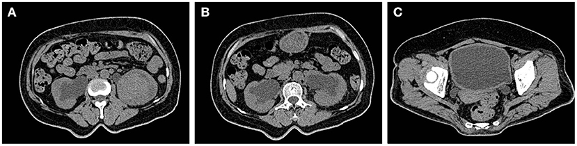 Frontiers | Clinical Analysis Of Renal Failure Caused By Malakoplakia ...